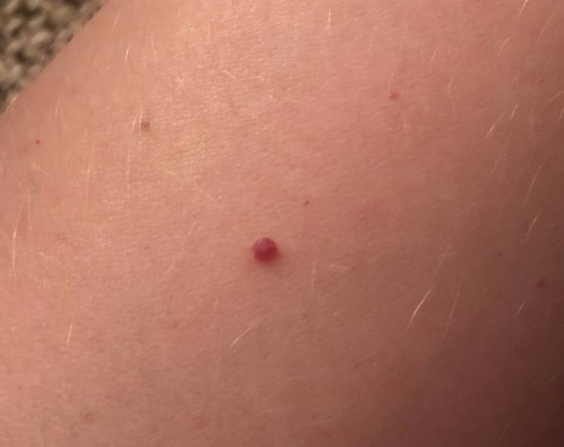 Cherry Angiomas