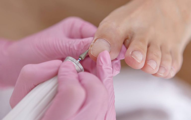 Ingrown Toenail treatment