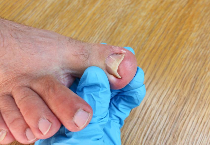 Ingrown Toenail: Causes And Treatment