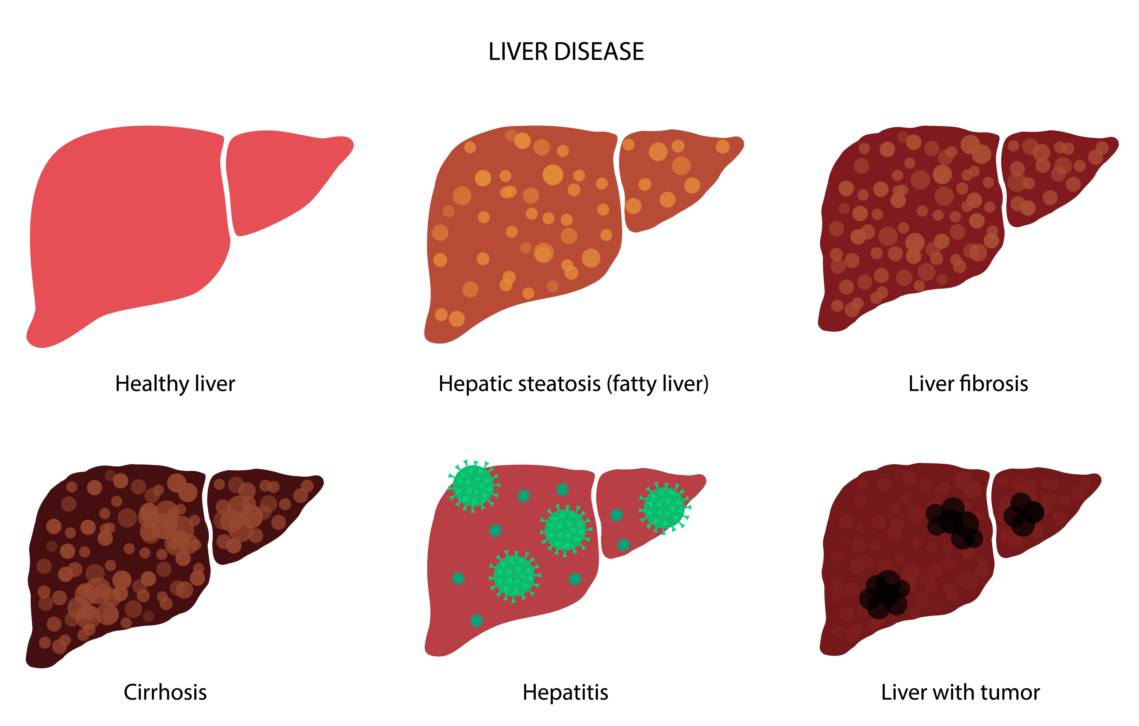 four stages of liver failure