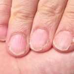 nail lines