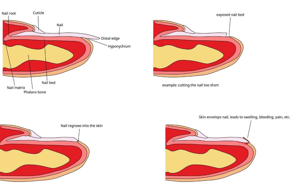 understanding-ingrown-nail-treatment