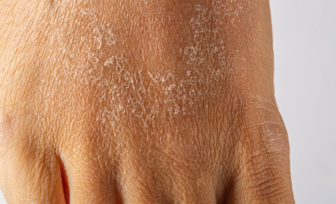 Persistent Skin Dryness