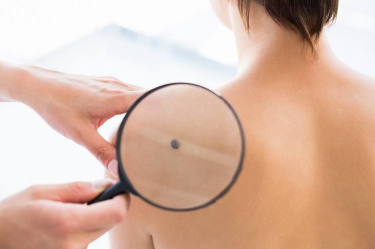 Skin Tag Removal